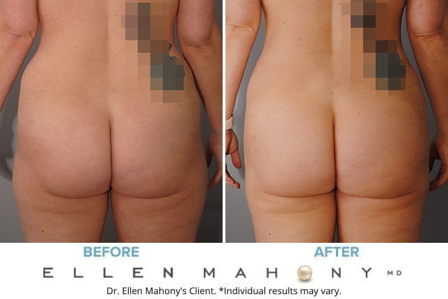 Before and After Image: Case #9278 - back