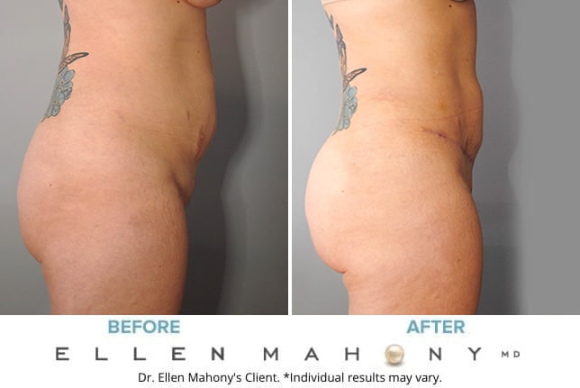 Before and After Image: Case #9278 - right-side