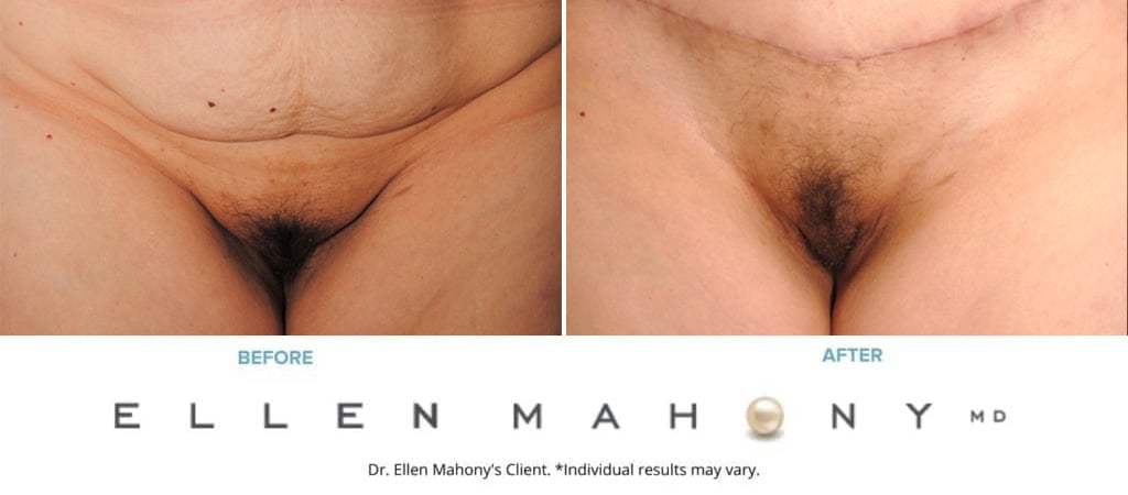 Before and After Image: Case #9356 - front