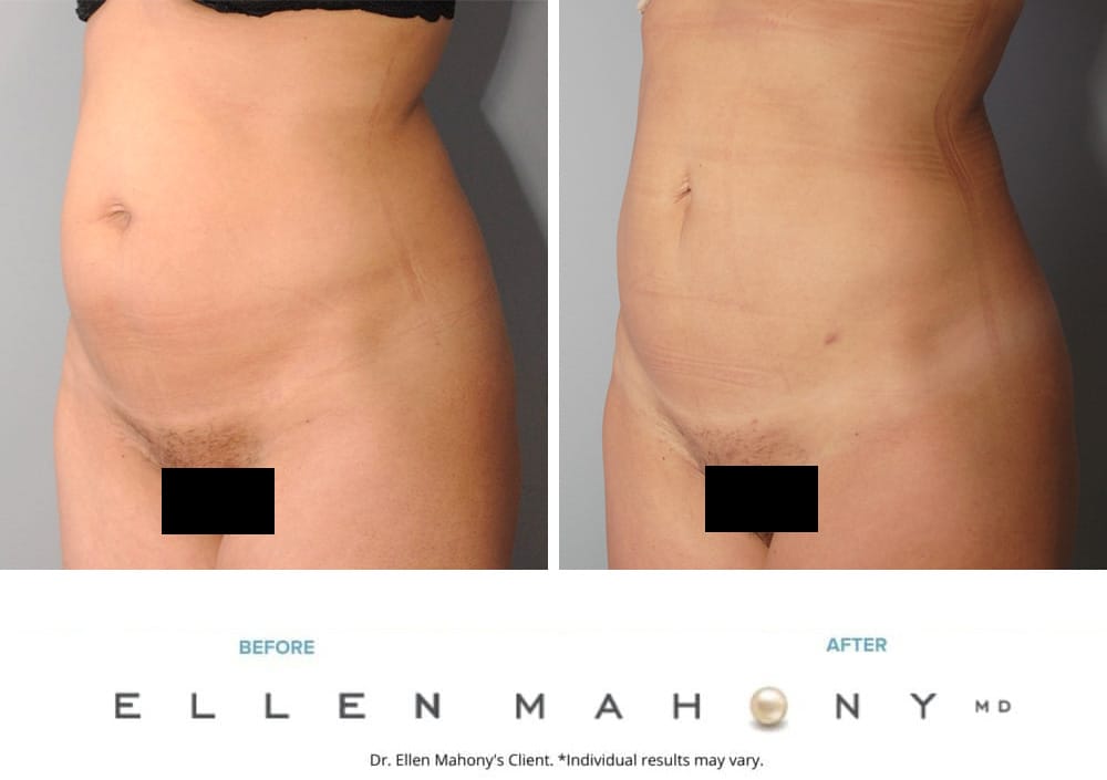 Before and After Image: Case #9611 - left-front-oblique