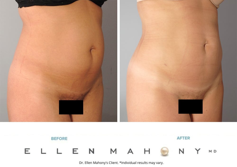 Before and After Image: Case #9611 - right-front-oblique