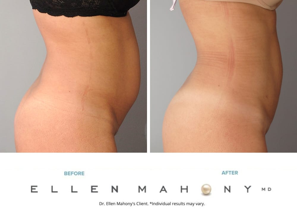 Before and After Image: Case #9611 - right-side