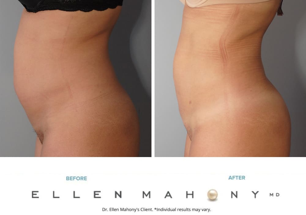 Before and After Image: Case #9611 - left-side