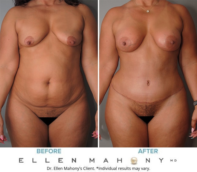 Before and After Image: Case #9673 - front