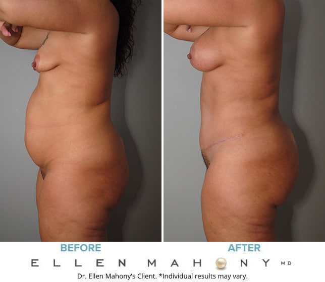 Before and After Image: Case #9673 - left-side