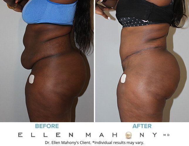 Before and After Image: Case #9937 - left-side