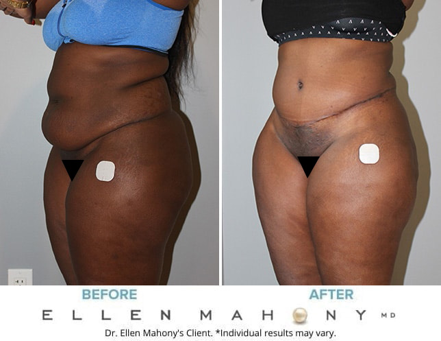 Before and After Image: Case #9937 - left-front-oblique