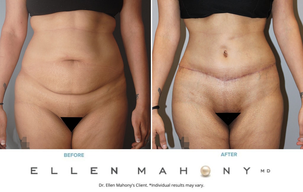 Before and After Image: Case #9959 - front