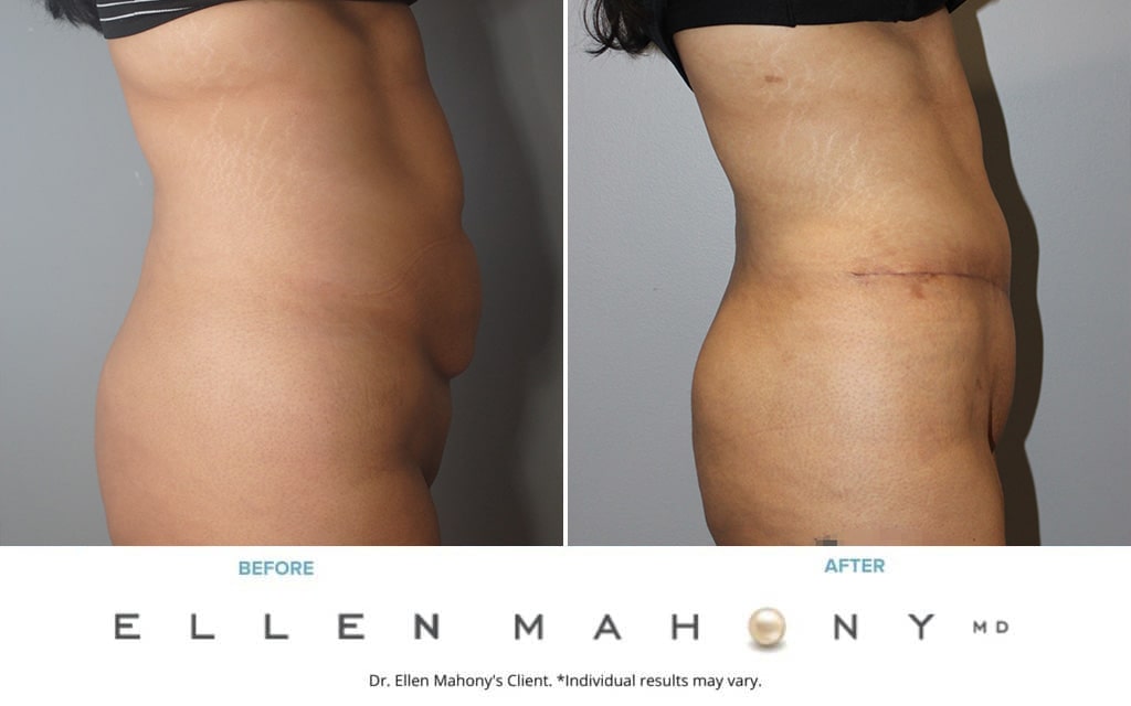 Before and After Image: Case #9959 - right-side