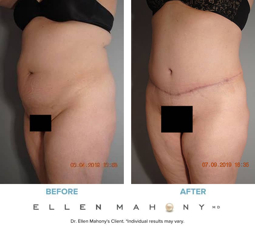 Before and After Image: Case #7912 - left-front-oblique