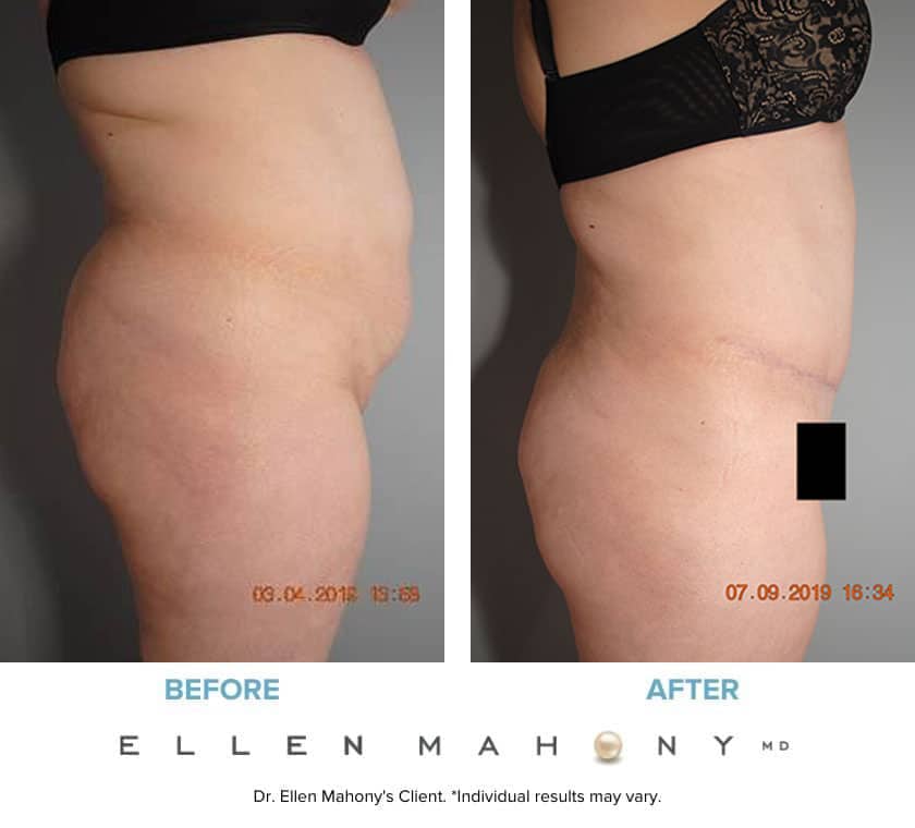 Before and After Image: Case #7912 - right-side