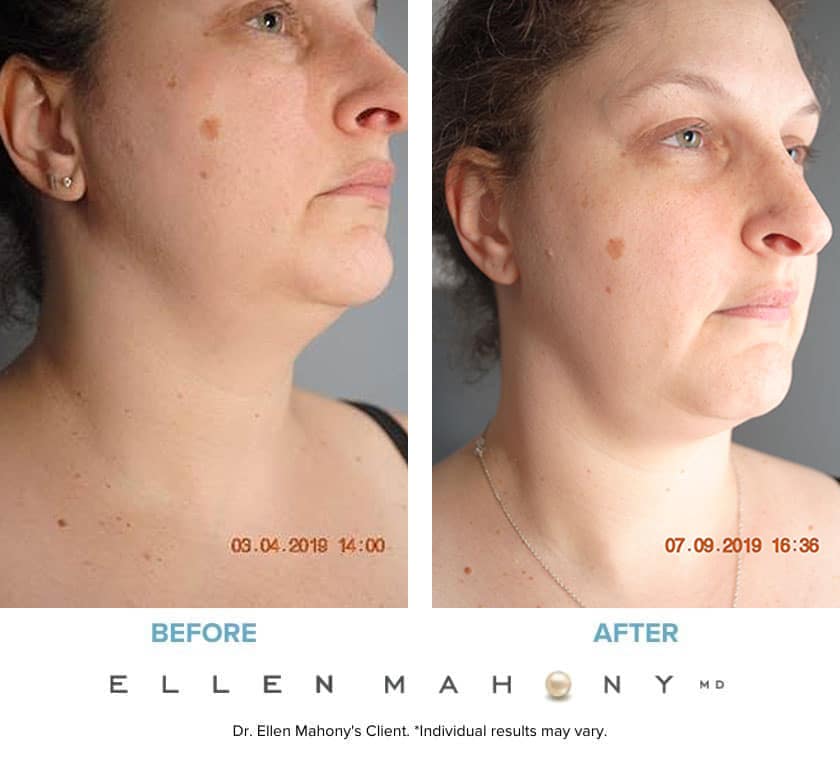 Before and After Image: Case #7912 - right-front-oblique