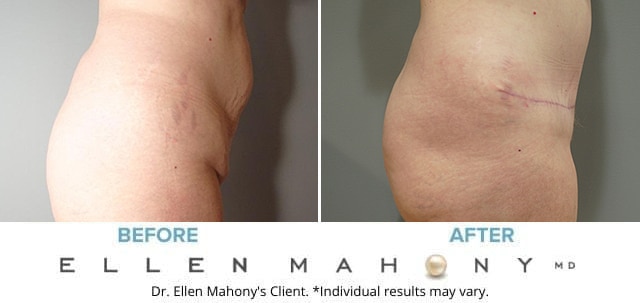 Before and After Image: Case #7395 - right-side