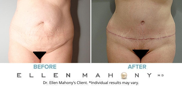 Before and After Image: Case #7395 - front