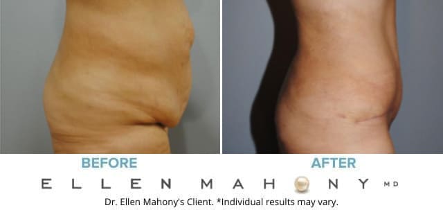 Before and After Image: Case #6310 - right-side