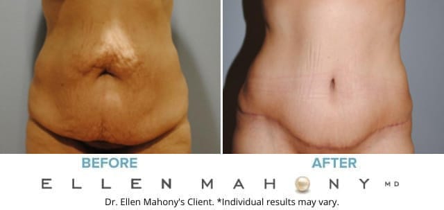 Before and After Image: Case #6310 - front