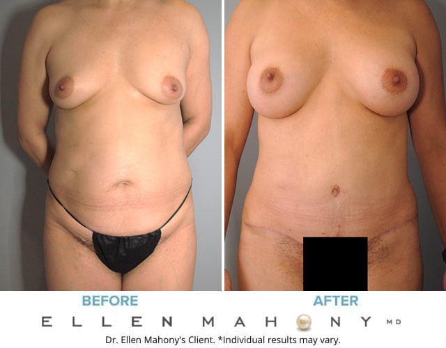 Before and After Image: Case #8819 - front