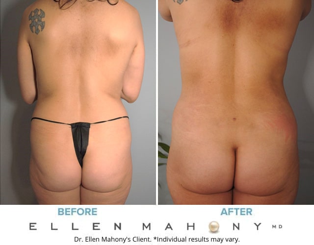 Before and After Image: Case #8819 - back