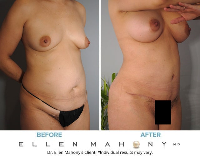 Before and After Image: Case #8819 - right-front-oblique