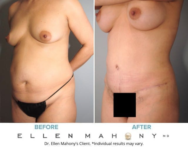 Before and After Image: Case #8819 - left-front-oblique