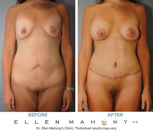 Before and After Image: Case #9364 - front