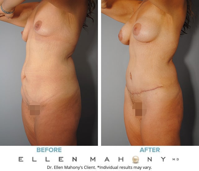Before and After Image: Case #9364 - left-front-oblique