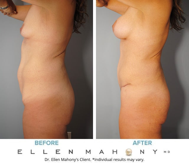 Before and After Image: Case #9364 - left-side