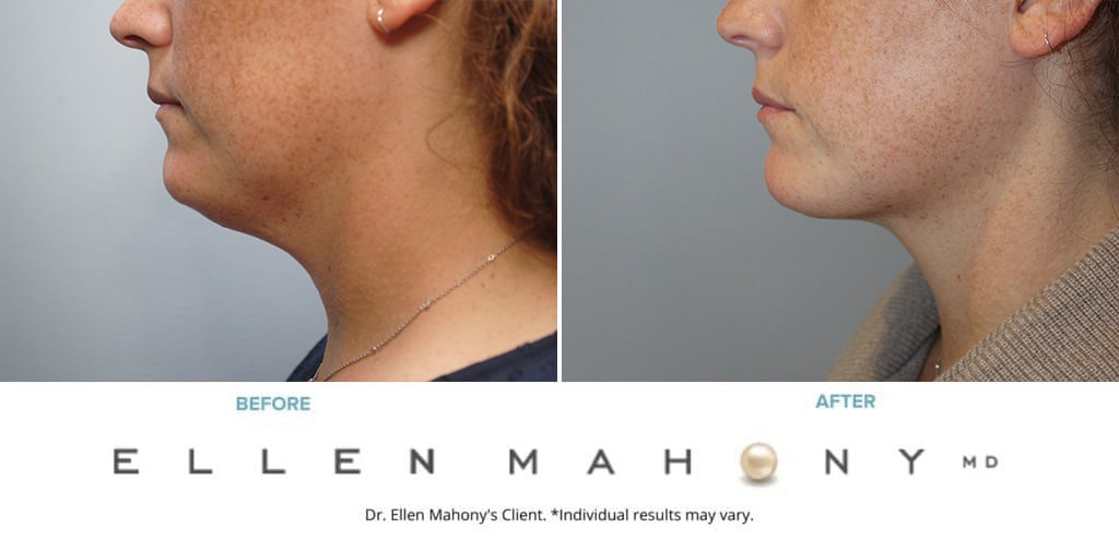 Before and After Image: Case #10254 - left-side