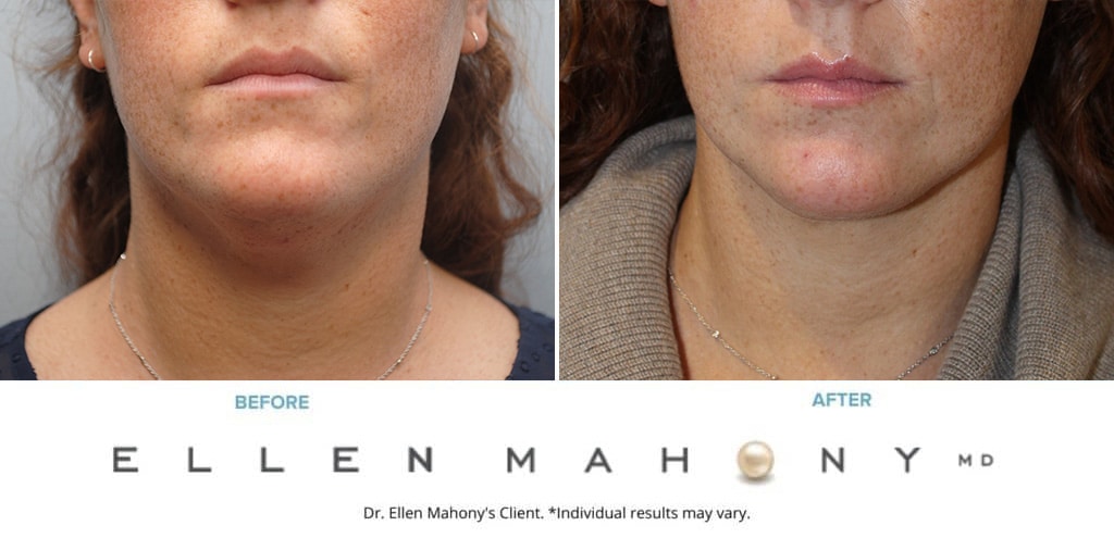 Before and After Image: Case #10254 - front