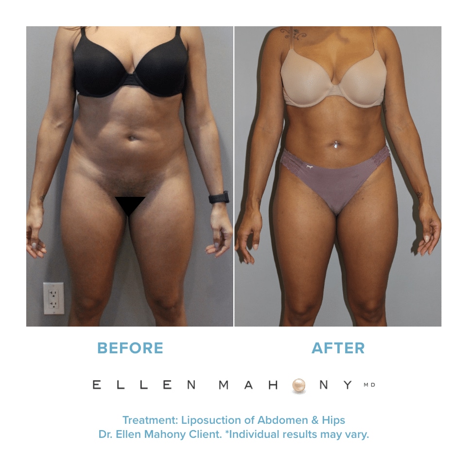 Before and After Image: Case #12181 - front