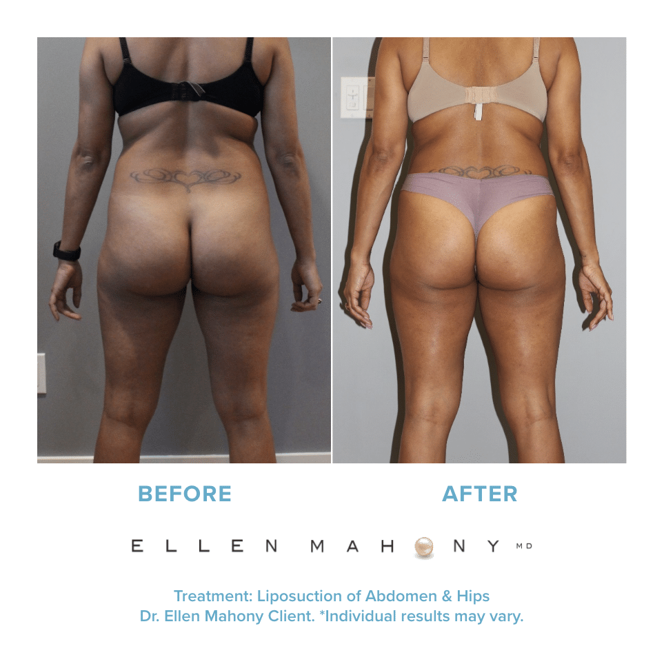Before and After Image: Case #12181 - back