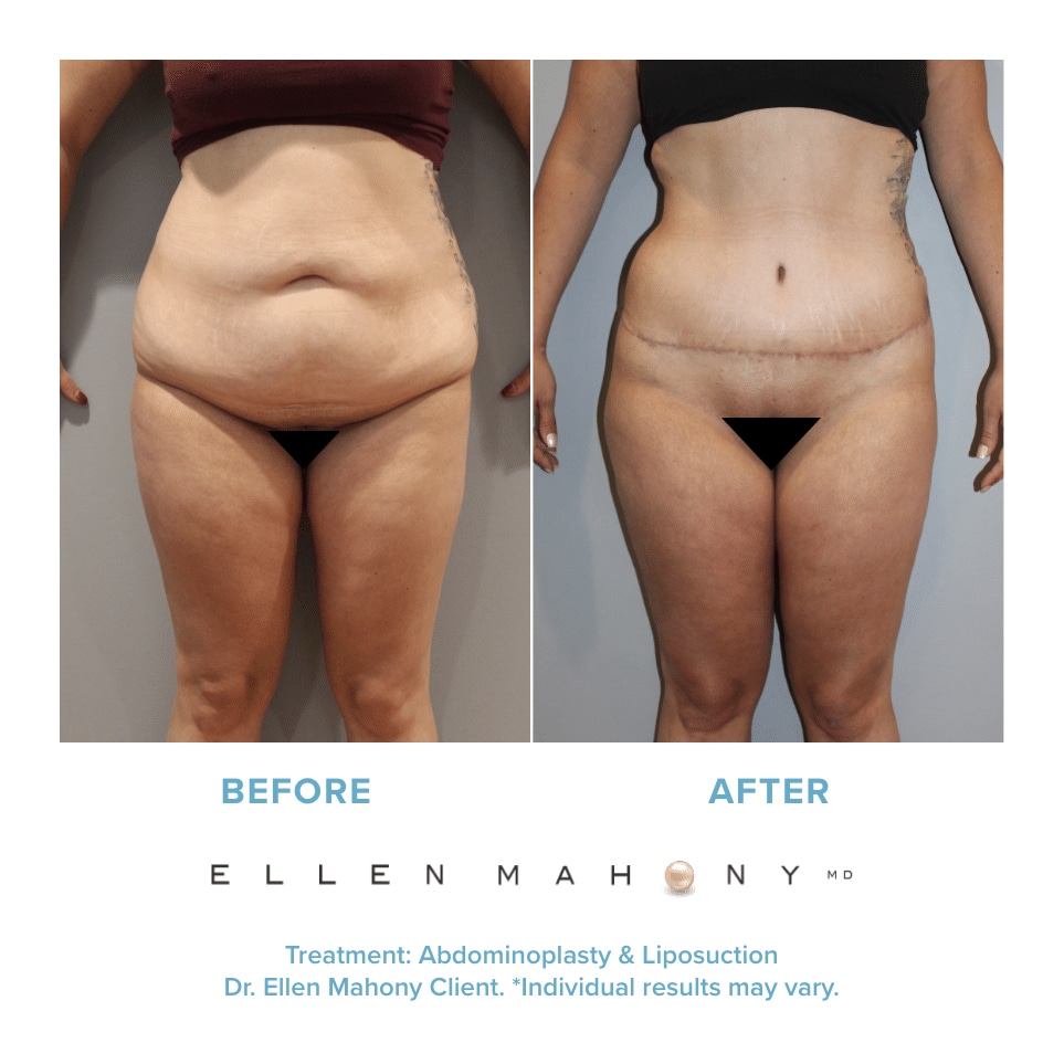 Before and After Image: Case #12217 - front