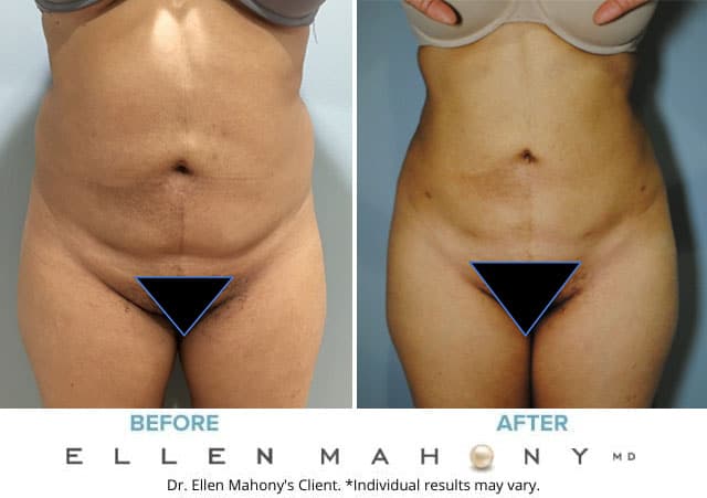 Before and After Image: Case #6692 - front