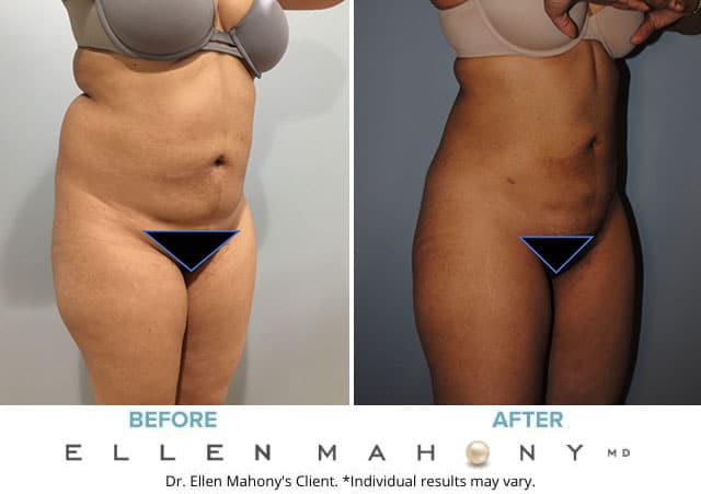 Before and After Image: Case #6692 - right-front-oblique