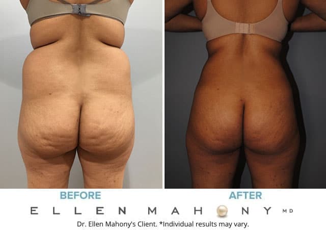 Before and After Image: Case #6692 - back