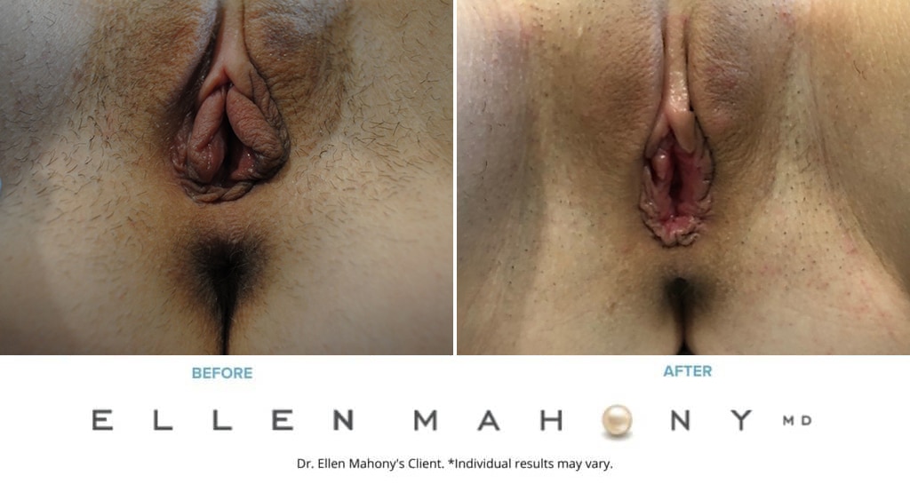 Before and After Image: Case #8912 - front