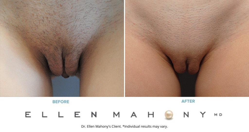 Before and After Image: Case #8912 - front