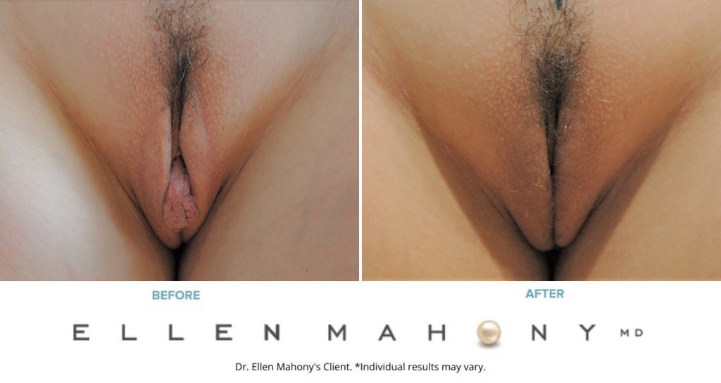 Before and After Image: Case #8915 - front