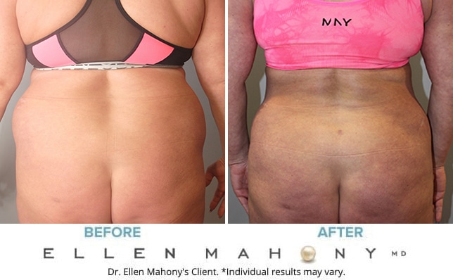 Before and After Image: Case #10468 - back
