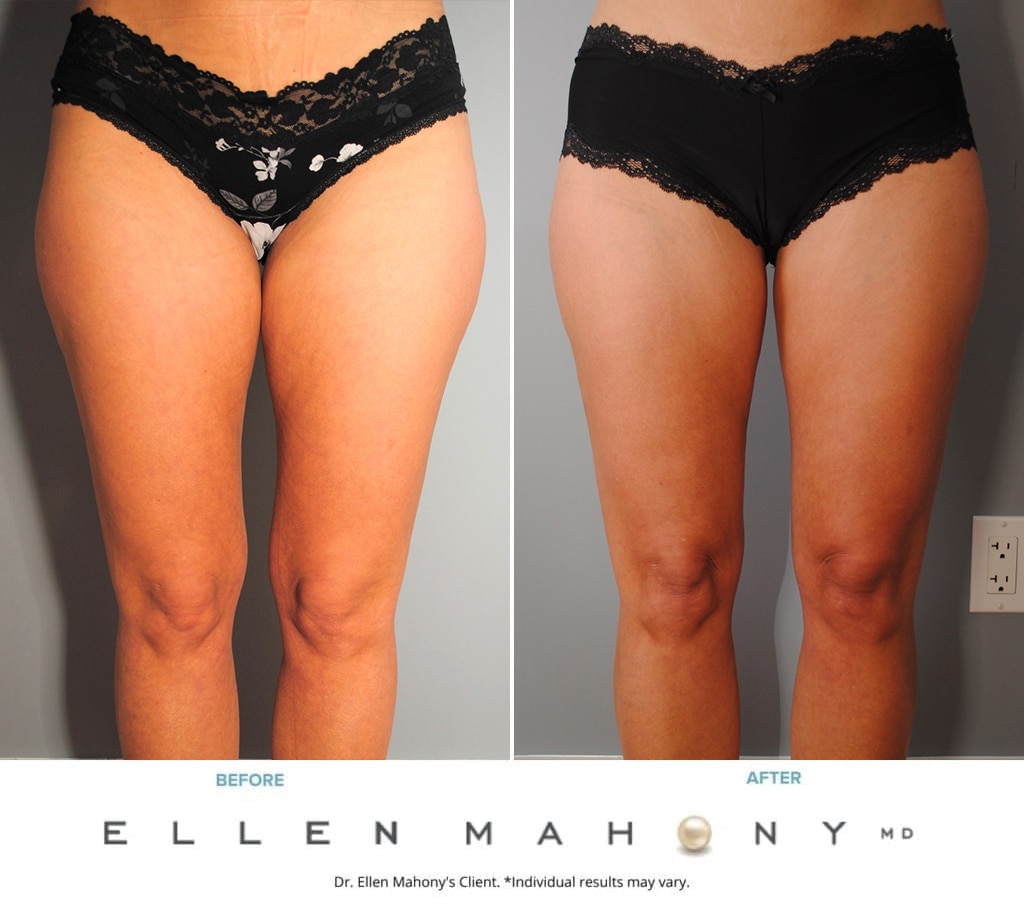 Before and After Image: Case #9728 - front
