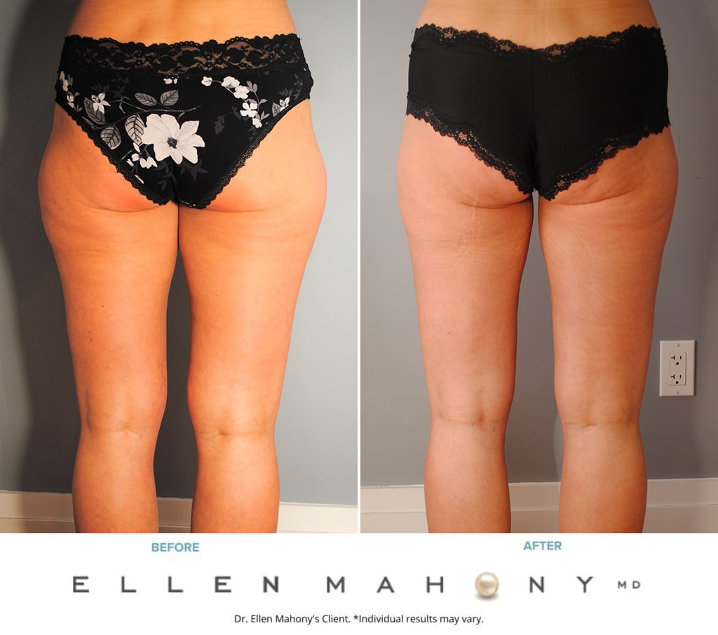 Before and After Image: Case #9728 - back