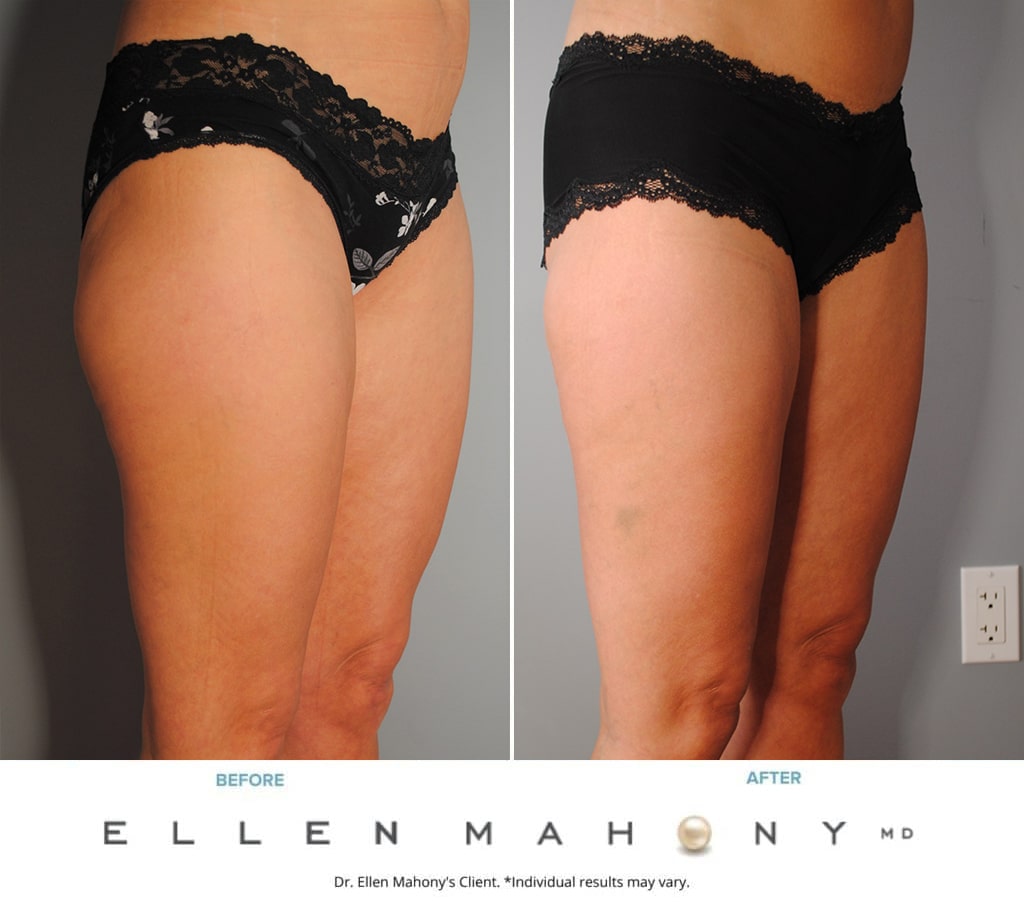 Before and After Image: Case #9728 - right-front-oblique