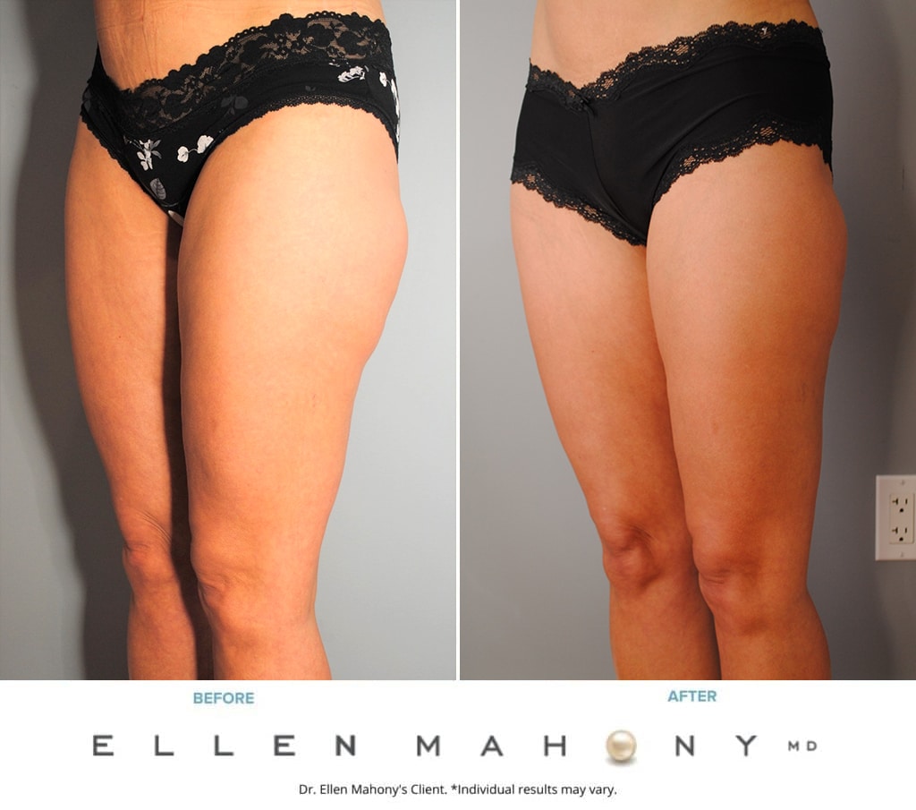 Before and After Image: Case #9728 - left-front-oblique