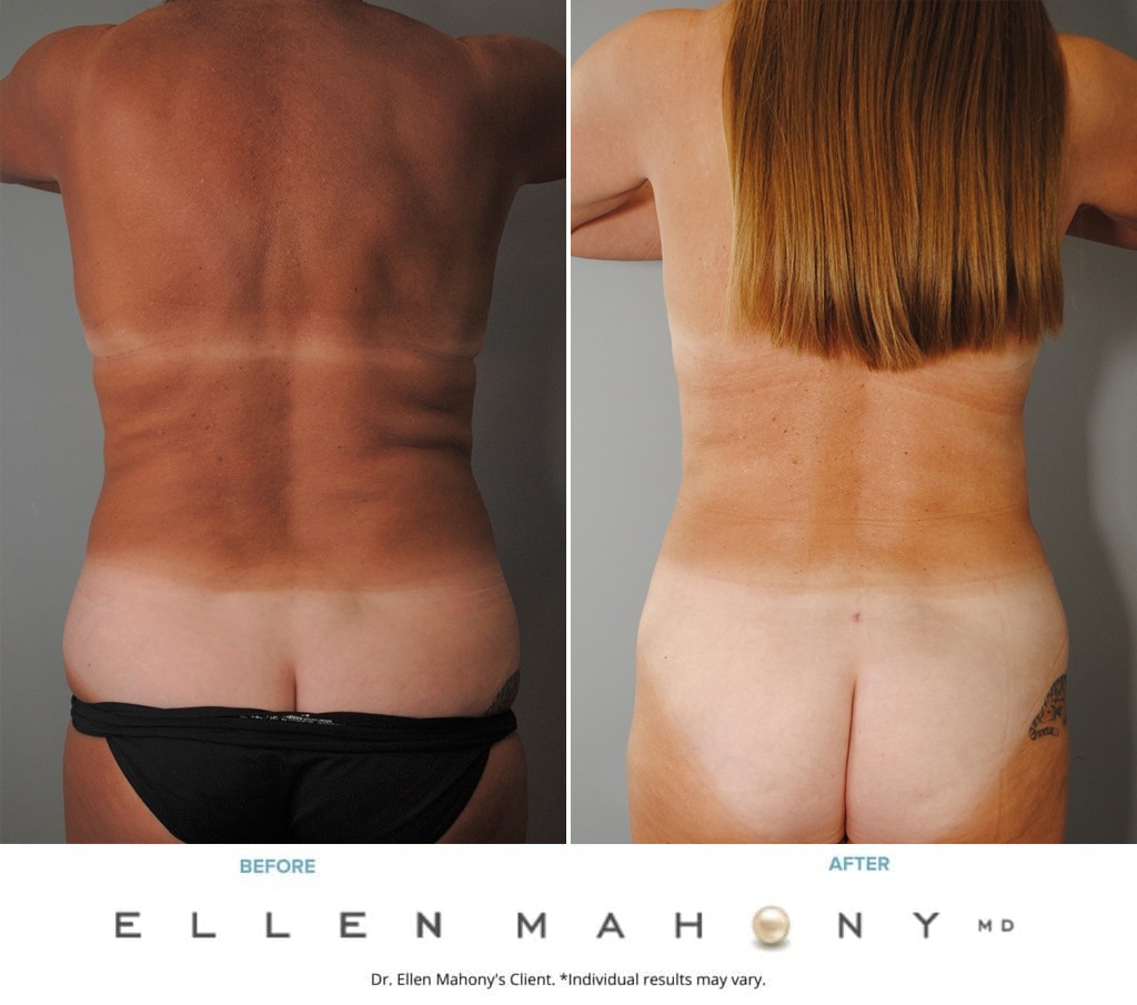 Before and After Image: Case #8997 - back