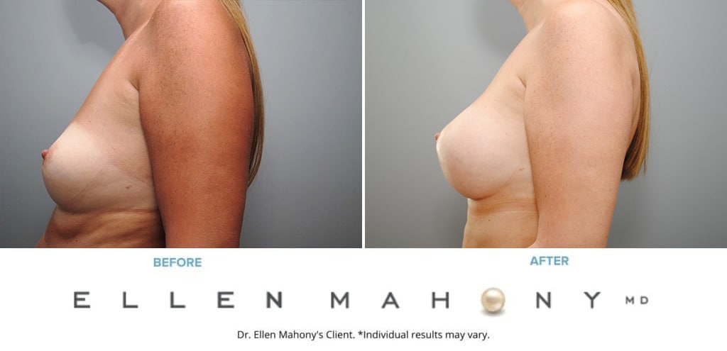 Before and After Image: Case #8997 - left-side