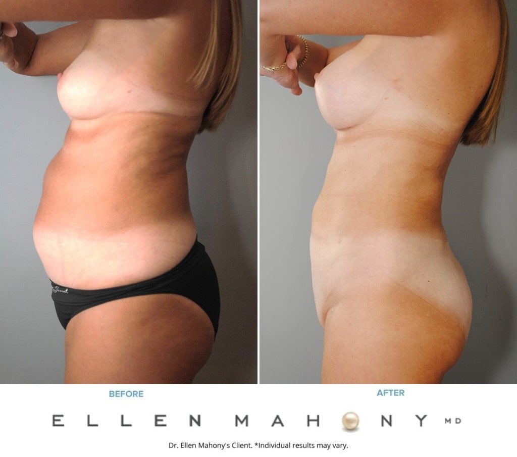 Before and After Image: Case #8997 - left-side