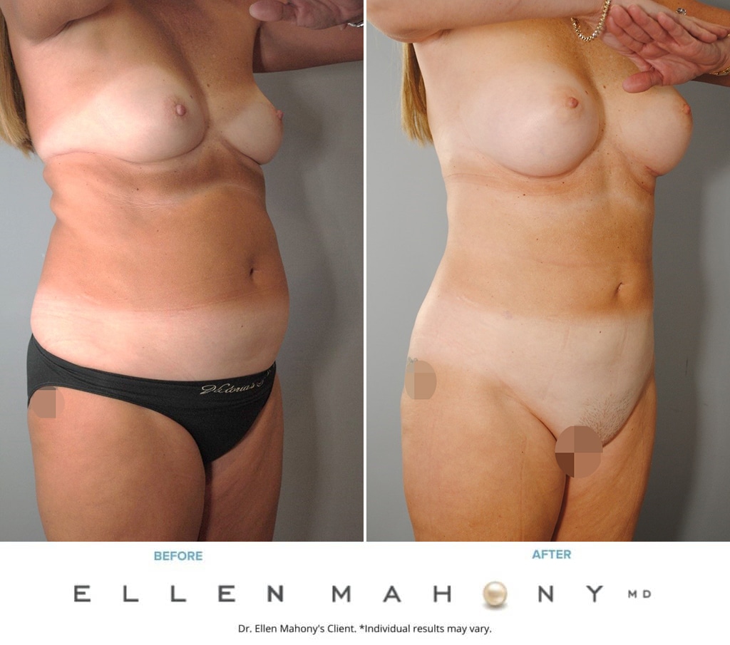Before and After Image: Case #8997 - right-front-oblique