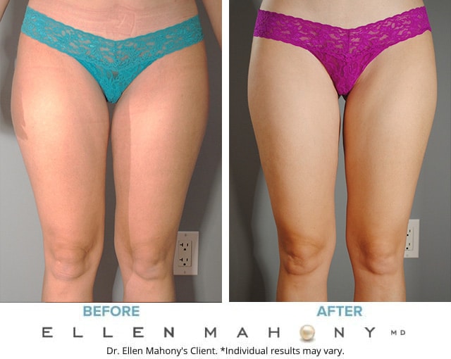 Before and After Image: Case #9316 - front