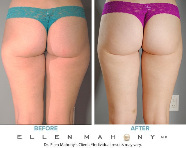 Before and After Image: Case #9316 - back