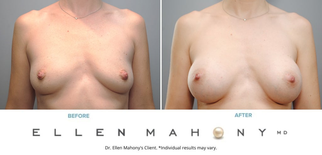 Before and After Image: Case #9316 - front